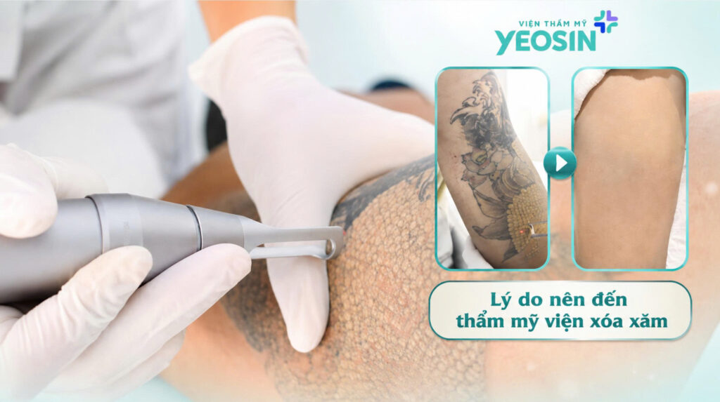 Lý do bạn nên đến thẩm mỹ viện xóa xăm
