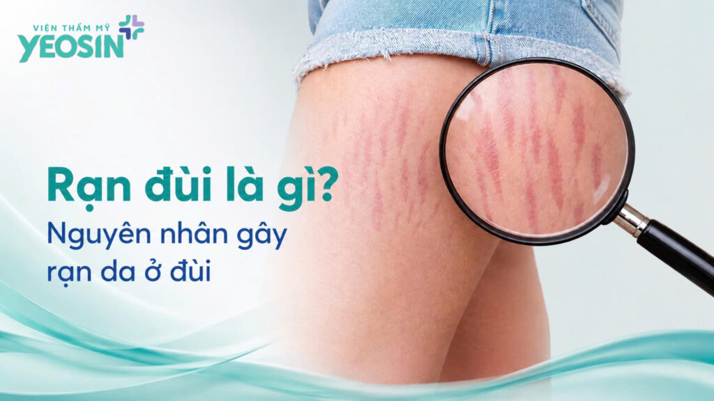 Rạn đùi - Cách trị rạn da ở đùi an toàn và hiệu quả nhất 5 6FDB7ADF E71D 4789 B914 FF65E21AB8CA