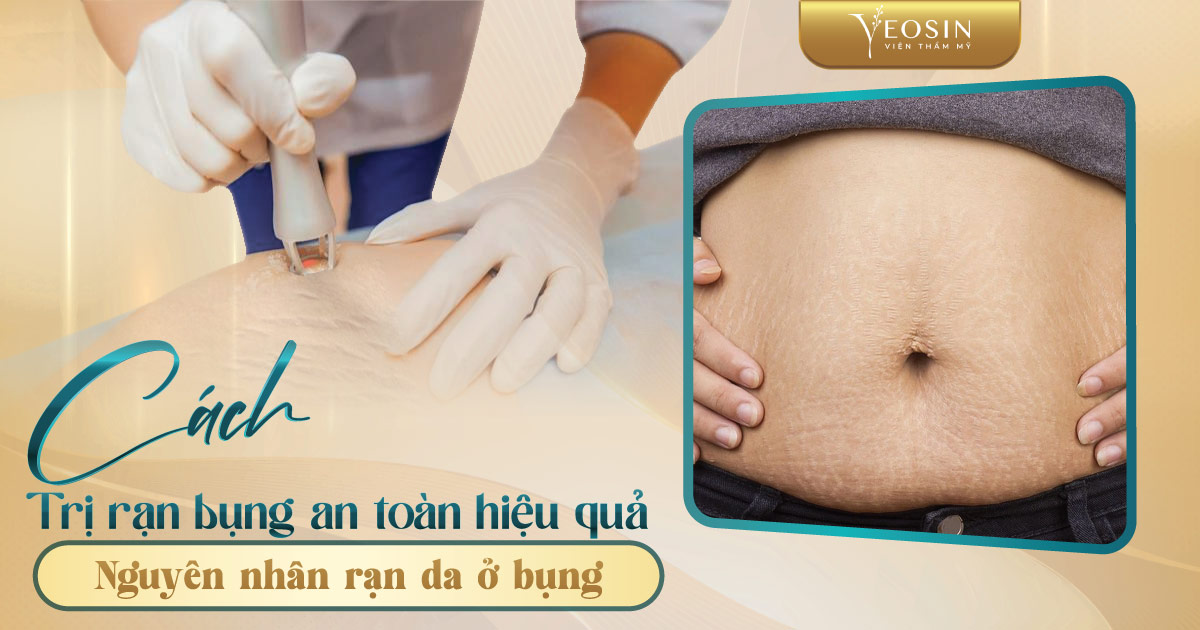 Bụng rạn - Nguyên nhân và cách trị rạn bụng an toàn hiệu quả