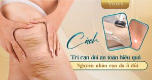 BANNER BLOG BIA RAN DA DUI