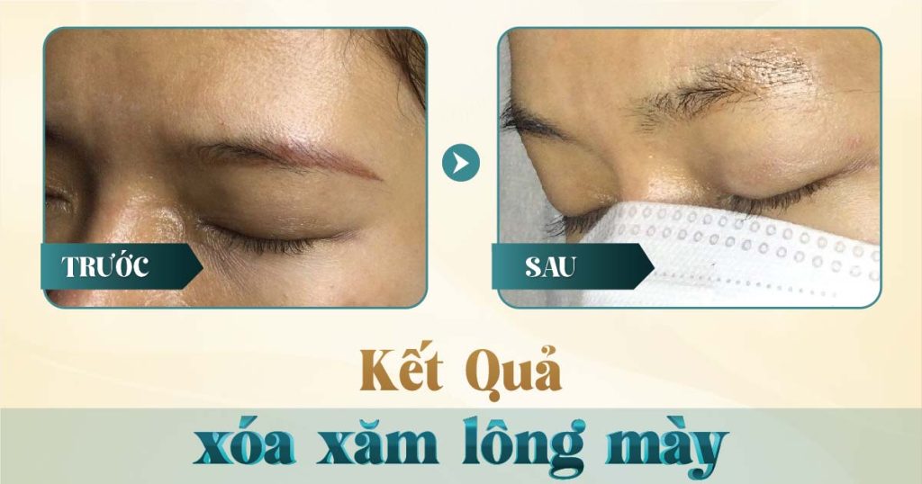 Xóa chân mày bằng laser có hết không? 18 Hình ảnh trước và sau khi xóa xăm mày bằng laser tại Viện Thẩm Mỹ Yeosin