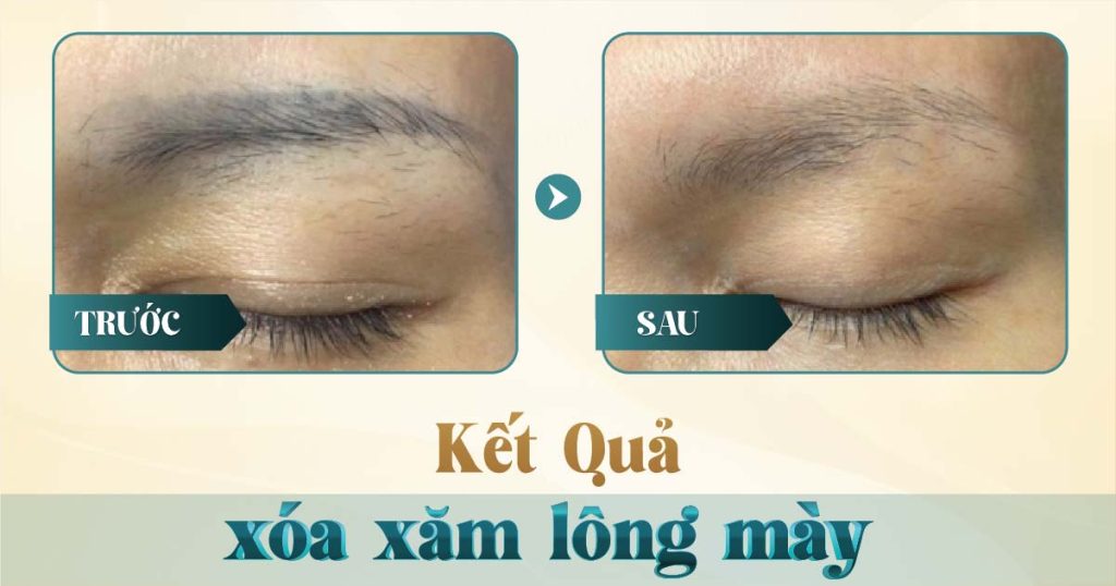 Xóa chân mày bằng laser có hết không? 17 Hình ảnh trước và sau khi xóa xăm mày bằng laser tại Viện Thẩm Mỹ Yeosin