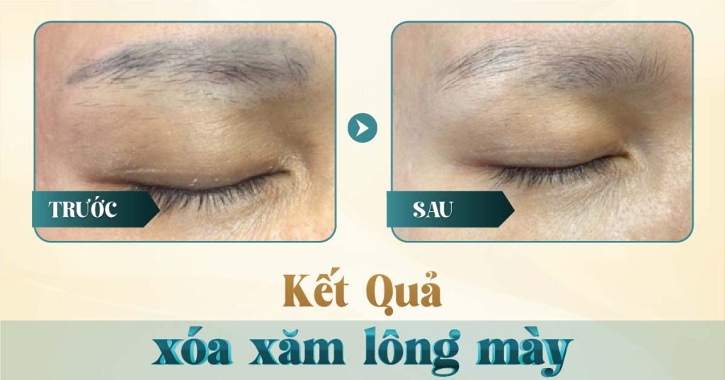 Xóa chân mày bằng laser có hết không? 16 Hình ảnh trước và sau khi xóa xăm mày bằng laser tại Viện Thẩm Mỹ Yeosin