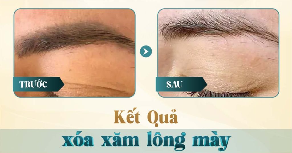 Xóa chân mày bằng laser có hết không? 15 Hình ảnh trước và sau khi xóa xăm mày bằng laser tại Viện Thẩm Mỹ Yeosin