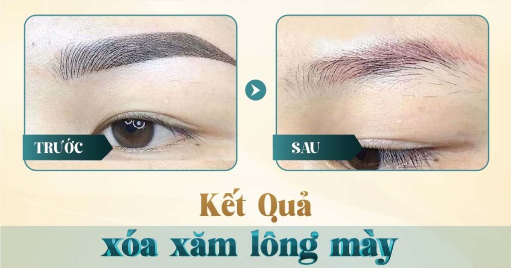 Xóa chân mày bằng laser có hết không? 14 Hình ảnh trước và sau khi xóa xăm mày bằng laser tại Viện Thẩm Mỹ Yeosin