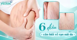 Rạn da và 6 điều cần biết về rạn nứt da