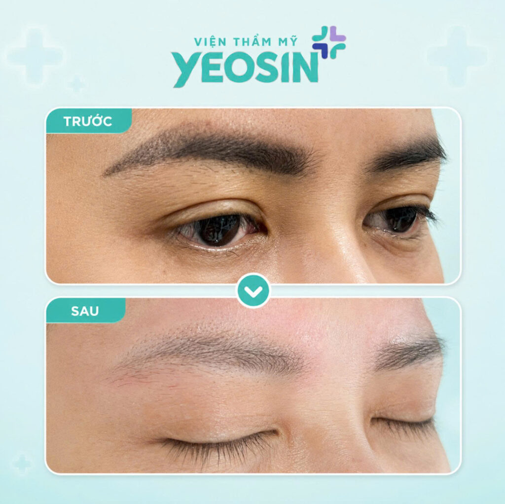 Hình ảnh sau khi xóa xăm lông mày tại Phòng Khám Thẩm Mỹ Yeosin