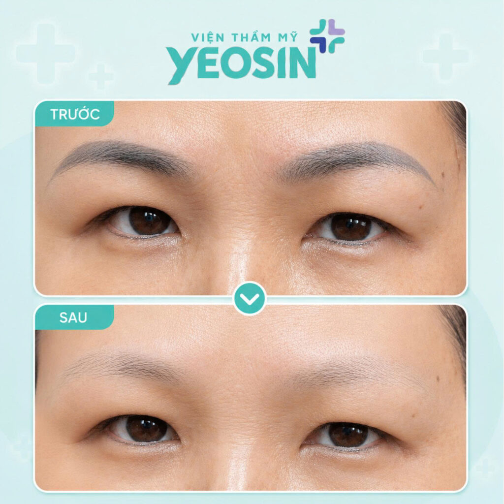 Hình ảnh sau khi xóa xăm lông mày tại Phòng Khám Thẩm Mỹ Yeosin