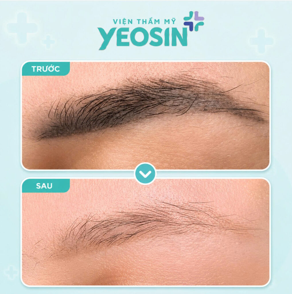 Hình ảnh sau khi xóa xăm lông mày tại Phòng Khám Thẩm Mỹ Yeosin