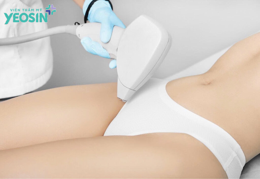 Triệt lông bikini tạo hình là gì? Xem những mẫu tạo hình đẹp nhất 7 Những lợi ích mang lại khi triệt lông tạo hình bikini