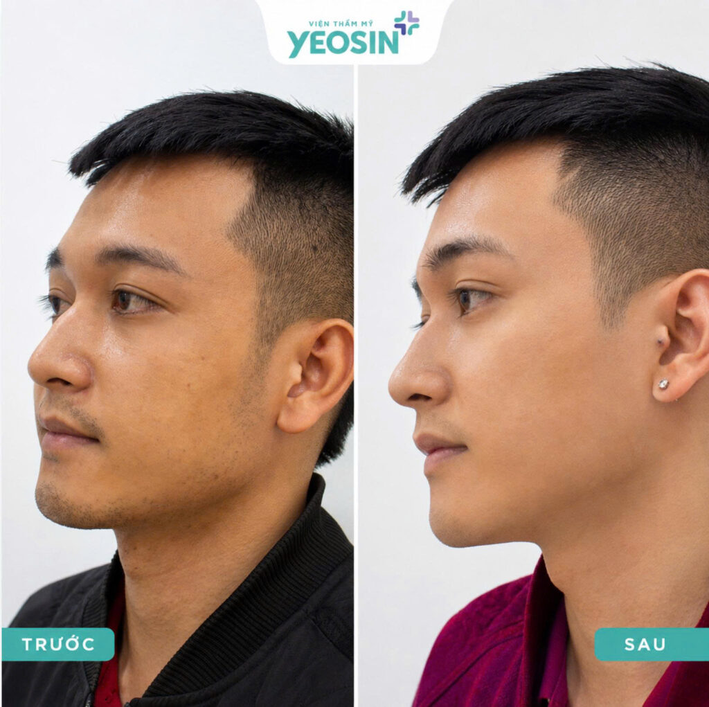 Gợi ý 5 cách triệt râu tại nhà an toàn và hiệu quả 14 Hình ảnh trước và sau khi triệt râu công nghệ Laser Ultra tại Phòng Khám Thẩm Mỹ Yeosin
