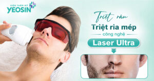 Triệt râu, triệt ria mép vĩnh viễn bằng công nghệ Laser Ultra