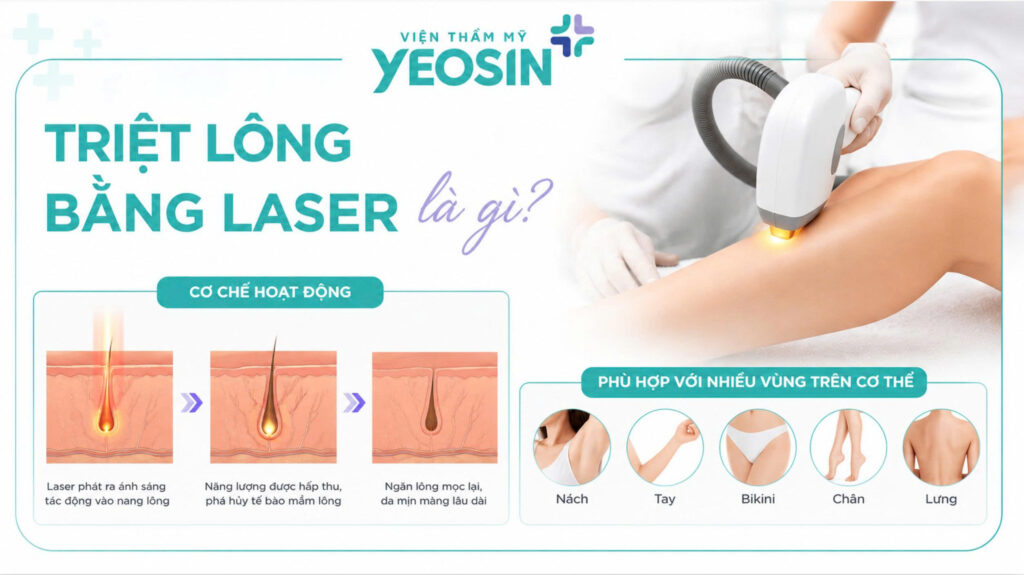 Triet-long-bang-laser-la-gi?