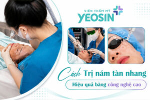 Cach tri nam tan nhang lau nam hieu qua bang cong nghe cao