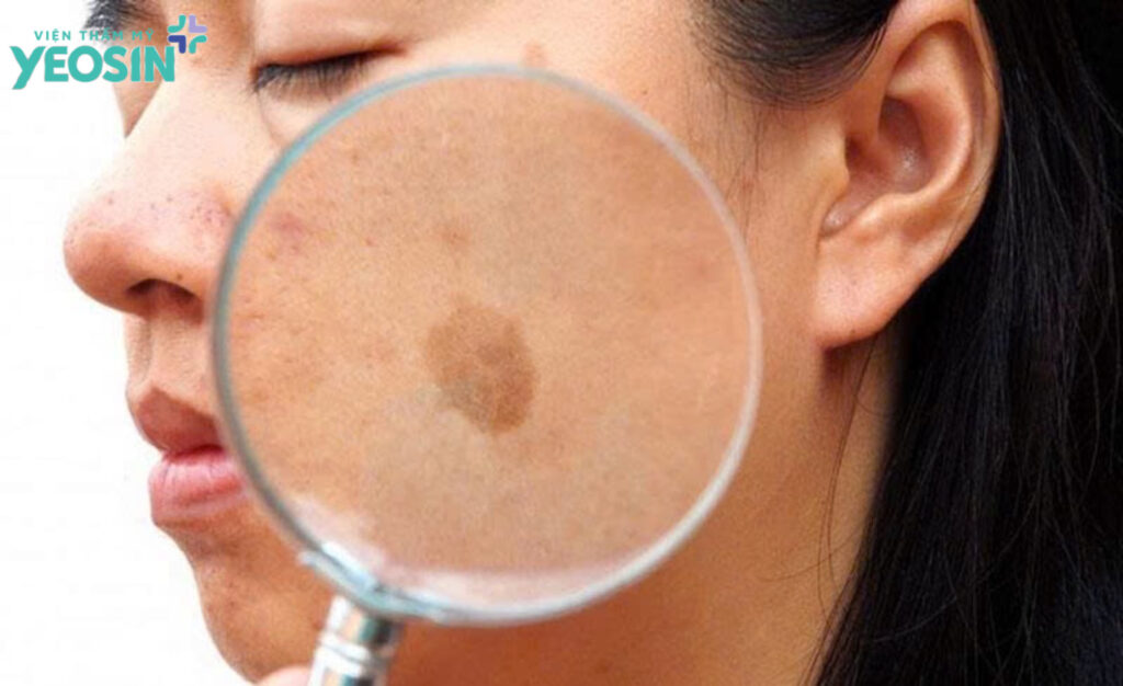 Da đồi mồi là gì? Nguyên nhân và cách xóa đốm nâu đồi mồi 6 E82C2F0F 9EE5 489C 91C7 3423723F08C2
