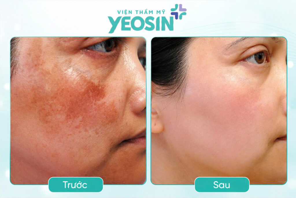 Hình ảnh trước và sau khi trị nám da mặt lâu năm tại Viện Thẩm Mỹ Yeosin