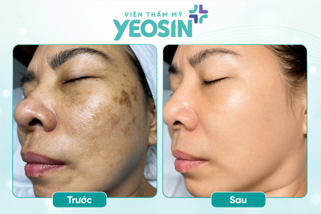 Hình ảnh trước và sau khi trị nám da mặt lâu năm tại Viện Thẩm Mỹ Yeosin