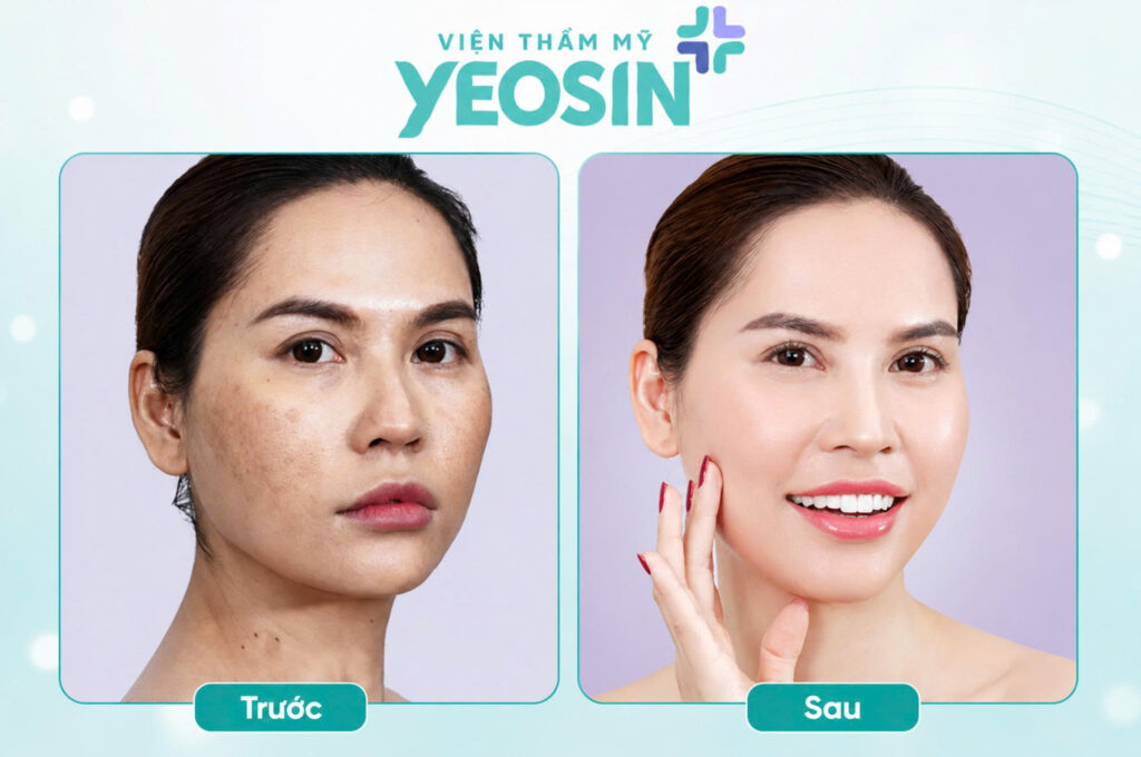 Hình ảnh trước và sau khi trị nám da mặt lâu năm tại Viện Thẩm Mỹ Yeosin