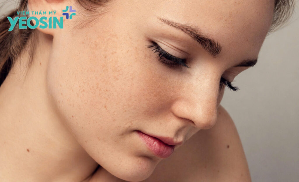 Nguyên nhân da mặt bị nám lâu năm