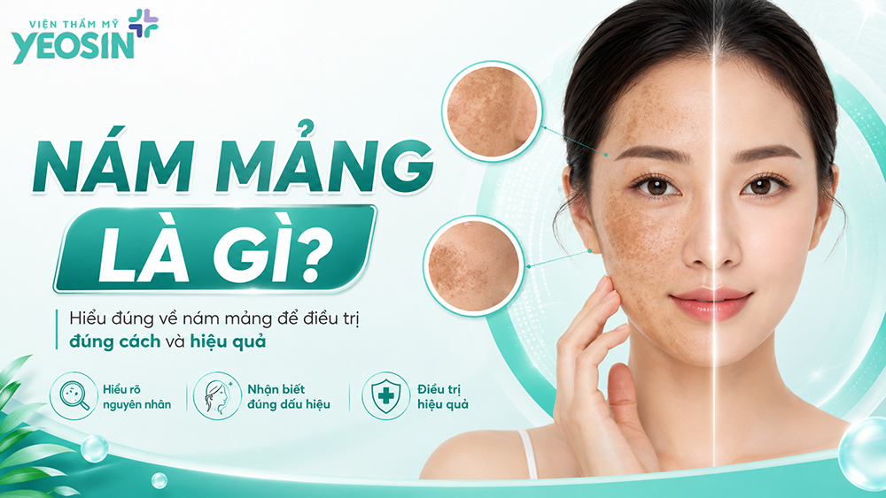 Nám mảng là gì?