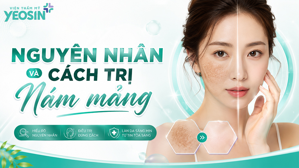 Nguyên nhân và cách điều trị nám mảng