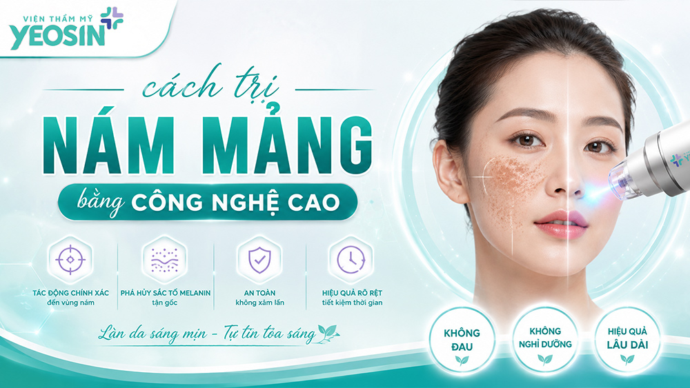 Trị nám mảng an toàn và hiệu quả bằng công nghệ cao