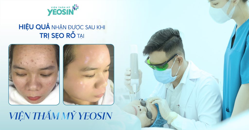 Hiệu quả nhận được sau khi trị sẹo rỗ tại Viện Thẩm Mỹ Yeosin