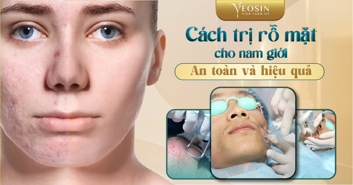 Cách trị rỗ mặt cho nam giới an toàn và hiệu quả