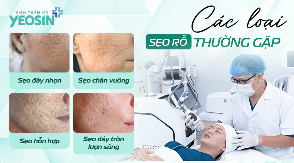 Các loại sẹo rỗ thường gặp