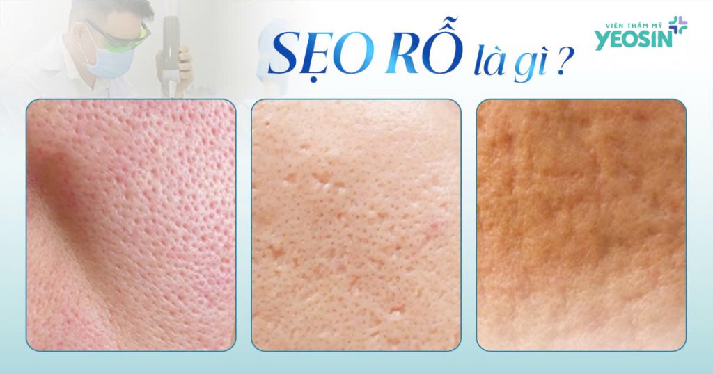 Sẹo rỗ là gì?
