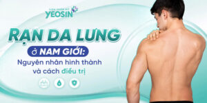 Rạn da lưng ở nam giới: Nguyên nhân hình thành và cách điều trị