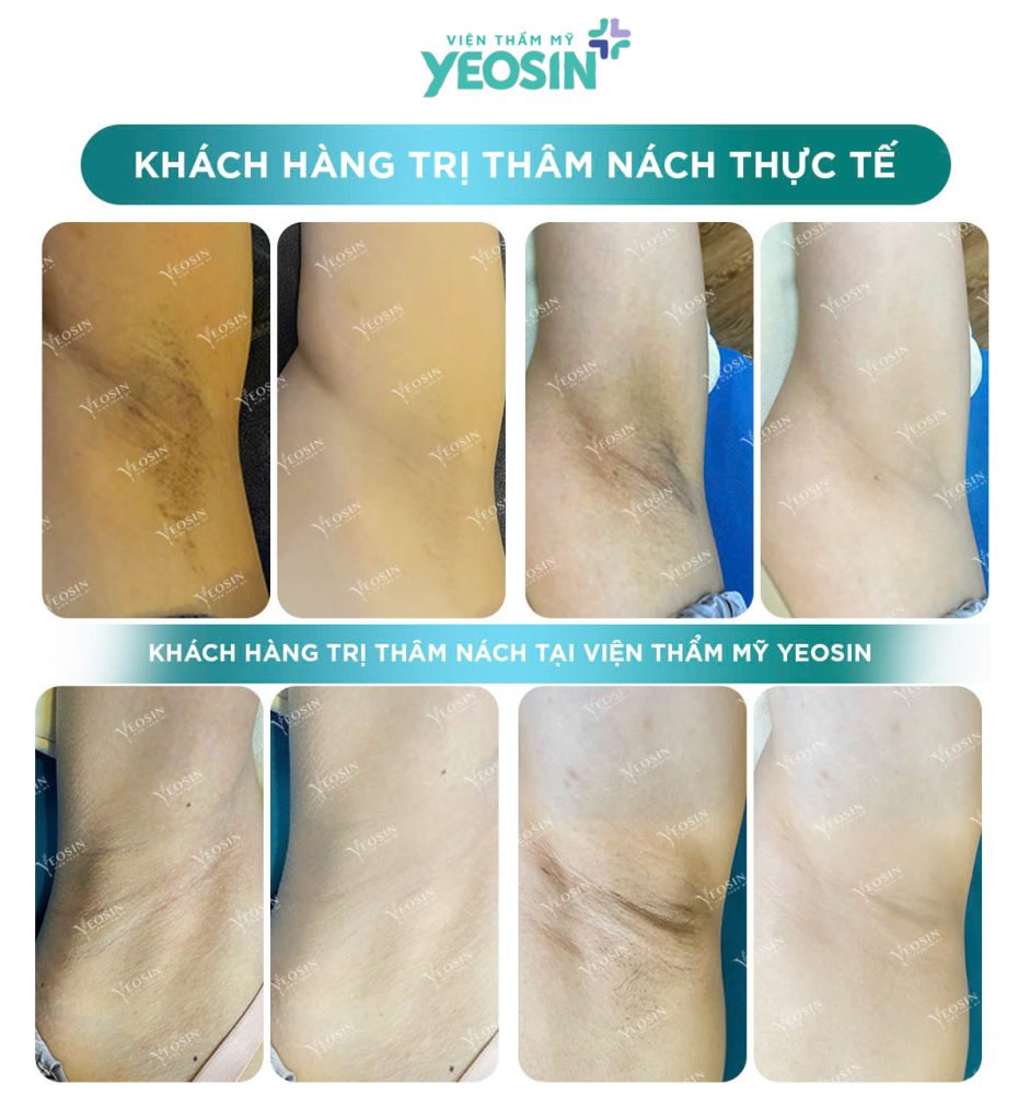 Trị Thâm Nách Công Nghệ Bio Skin Hiệu Quả Tại Phòng Khám Thẩm Mỹ Yeosin 21 Trị Thâm Nách Công Nghệ Bio Skin Hiệu Quả Tại Viện Thẩm Mỹ Yeosin