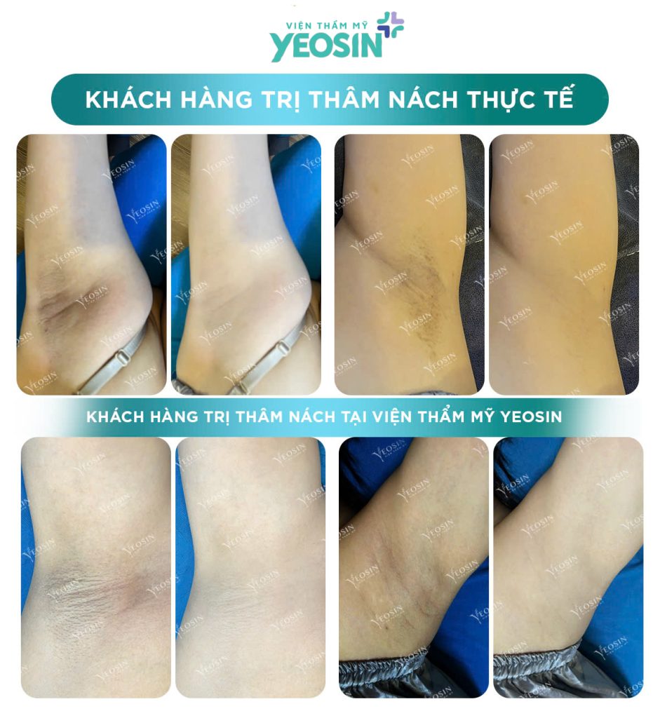 Trị Thâm Nách Công Nghệ Bio Skin Hiệu Quả Tại Phòng Khám Thẩm Mỹ Yeosin 22 z6429908121048 634734d91b62764c8df880fddc461231