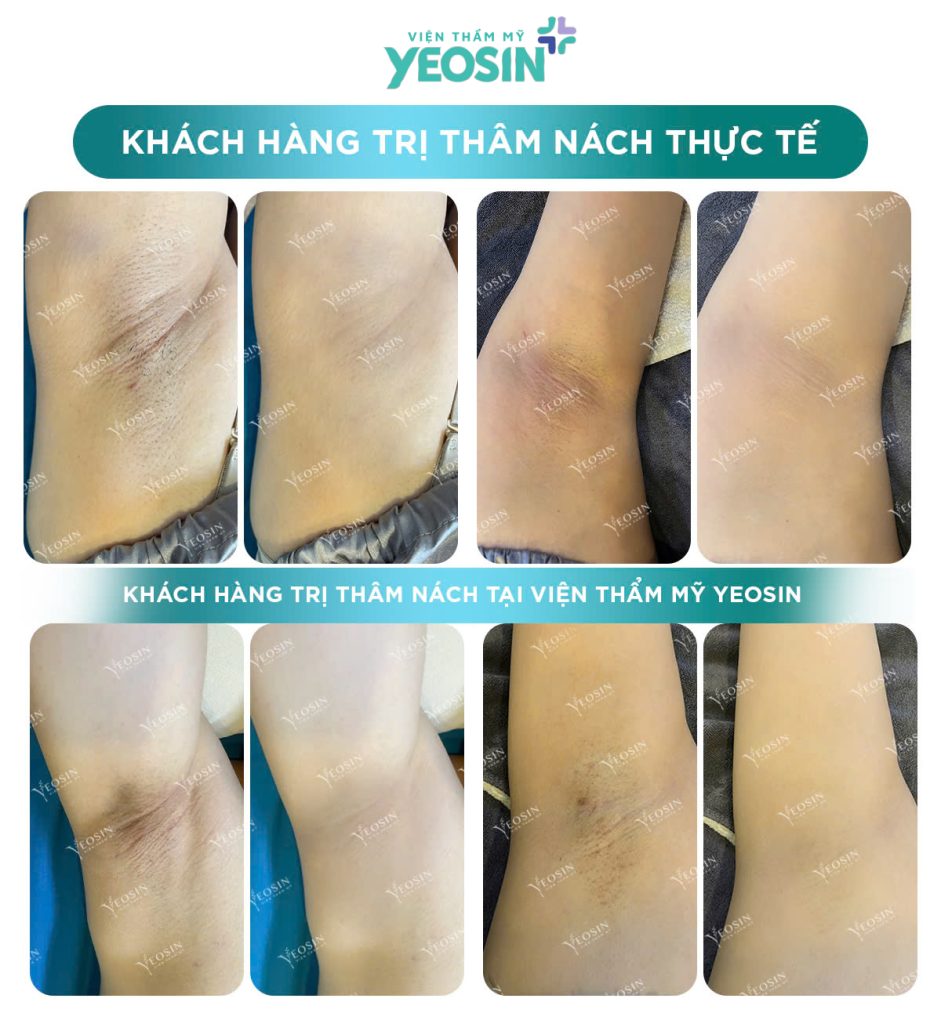 Trị Thâm Nách Công Nghệ Bio Skin Hiệu Quả Tại Phòng Khám Thẩm Mỹ Yeosin 23 Trị Thâm Nách Công Nghệ Bio Skin Hiệu Quả Tại Viện Thẩm Mỹ Yeosin