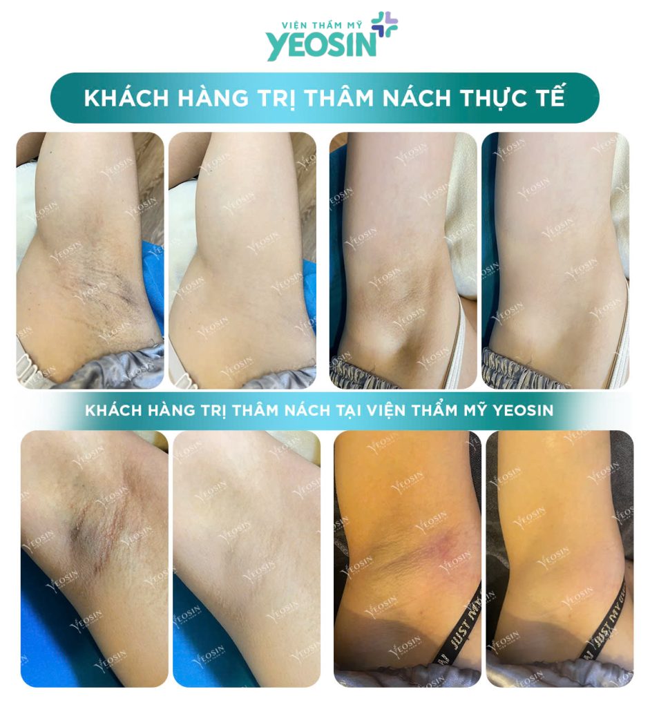 Trị Thâm Nách Công Nghệ Bio Skin Hiệu Quả Tại Phòng Khám Thẩm Mỹ Yeosin 24 z6429908128169 759968cdbcd20152a6c19544833a6f29