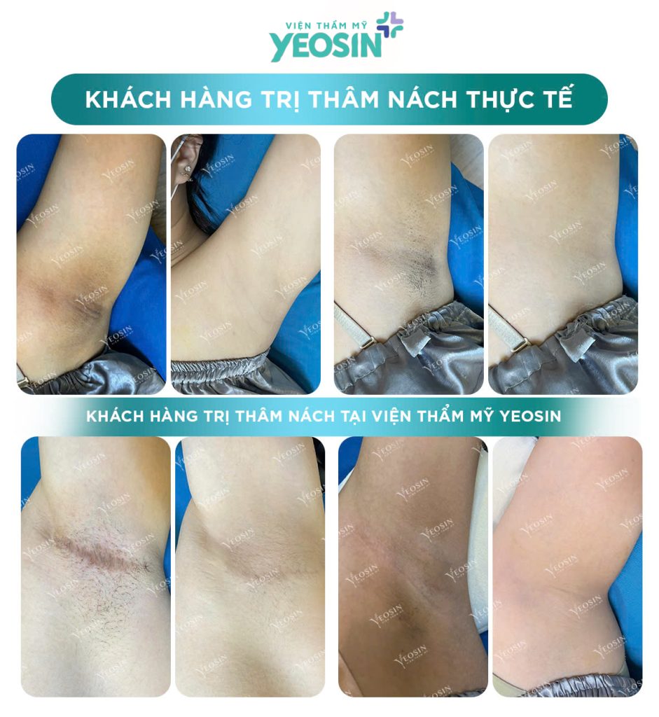 Trị Thâm Nách Công Nghệ Bio Skin Hiệu Quả Tại Phòng Khám Thẩm Mỹ Yeosin 25 z6429908135232 693d9405aed36e6dc519865a7aea168a