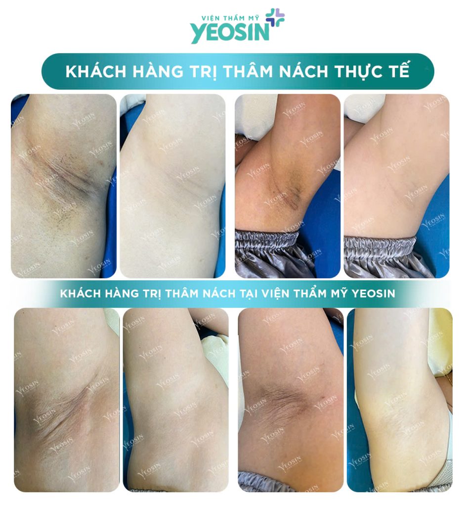 Trị Thâm Nách Công Nghệ Bio Skin Hiệu Quả Tại Phòng Khám Thẩm Mỹ Yeosin 26 z6429908139874 acd1eccdfb58a1f7cbbceea4471af455