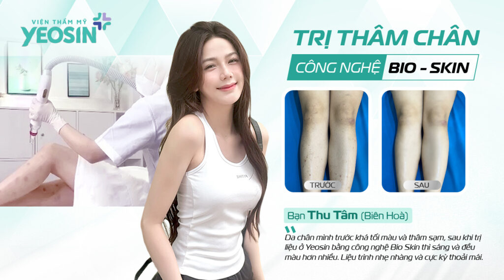 Trị Thâm Chân Công Nghệ Bio Skin Hiệu Quả Tại Viện Thẩm Mỹ Yeosin 22 Fb ban Thu Tam