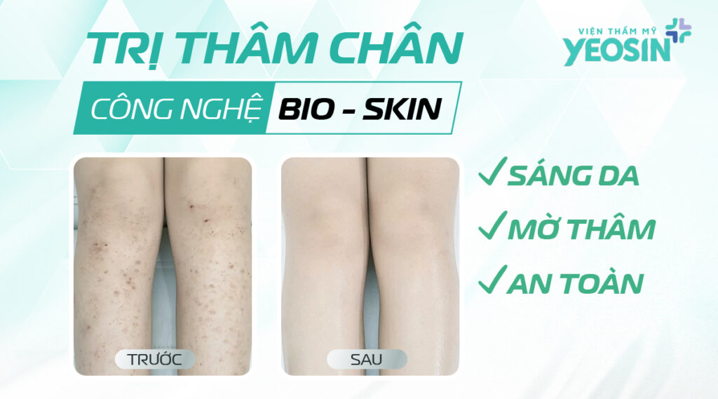 tri tham chan bang cong nghe bio skin