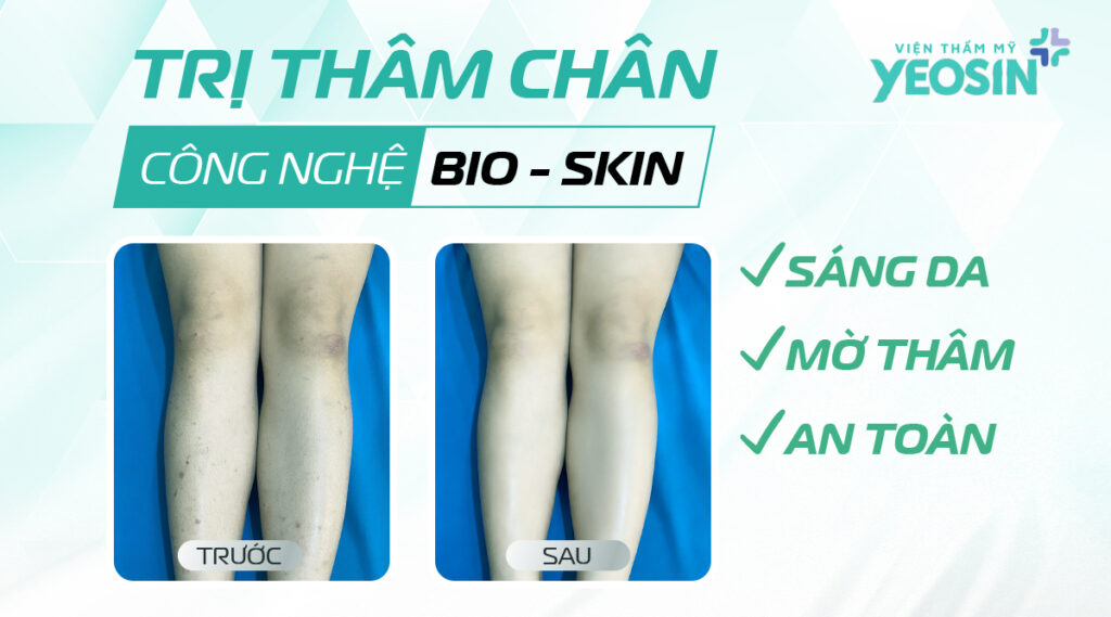 tri tham chan bang cong nghe bio skin 2