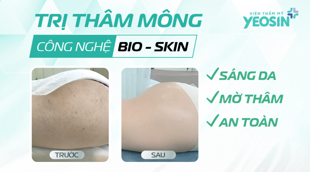 tri tham mong bang cong nghe bio skin