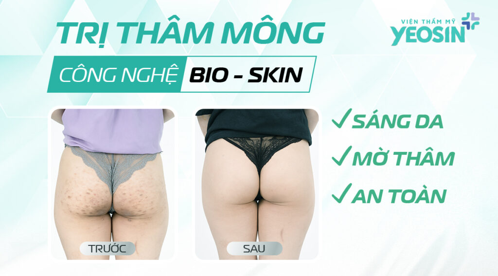 tri tham mong bang cong nghe bio skin 2