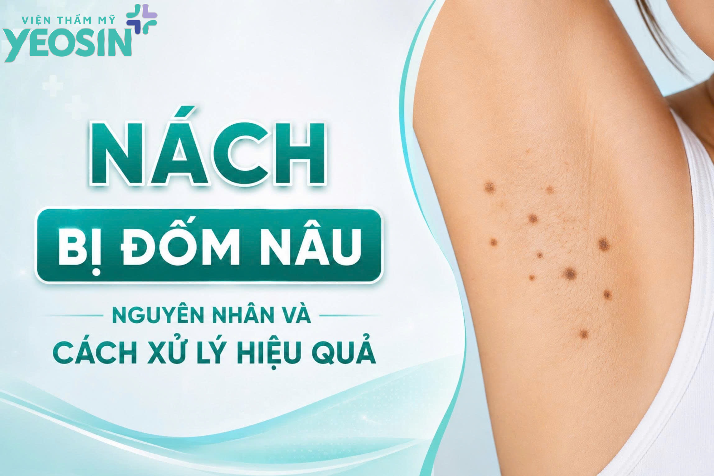 Nách bị đốm nâu: Nguyên nhân và cách xử lý hiệu quả