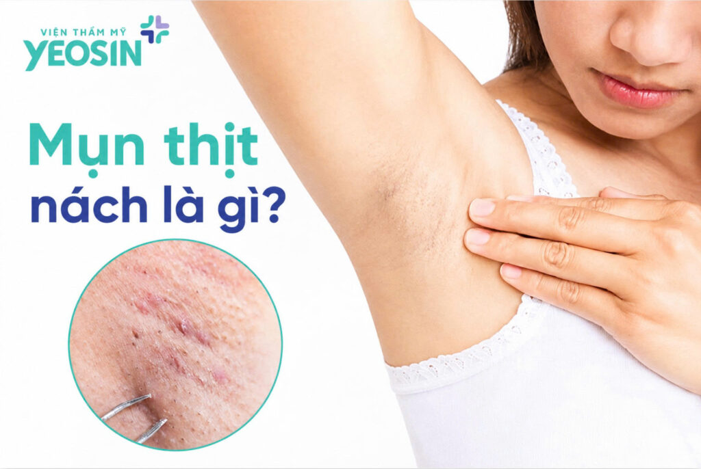Mụn thịt ở nách: Nguyên nhân, cách xử lý hiệu quả 5 Mụn thịt ở nách là gì?