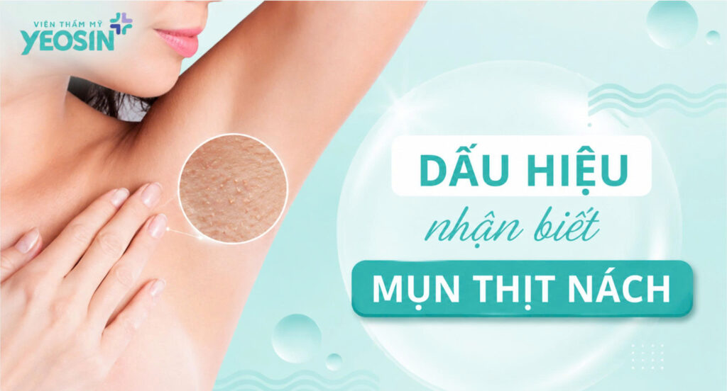 Mụn thịt ở nách: Nguyên nhân, cách xử lý hiệu quả 6 Dấu hiệu nhận biết mụn thịt ở nách