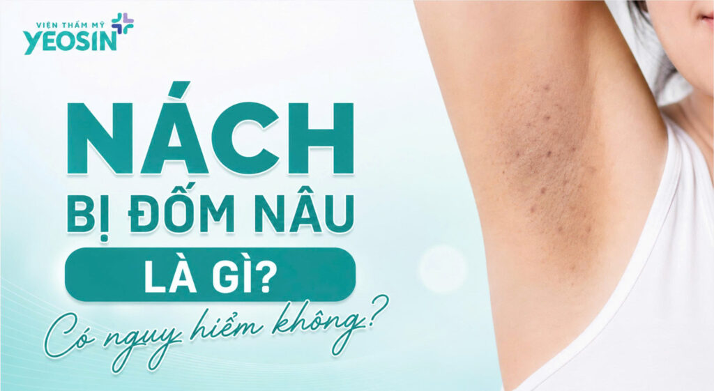 Nách bị đốm nâu: Nguyên nhân và cách xử lý hiệu quả 7 Nách bị đốm nâu là gì? Có nguy hiểm không?
