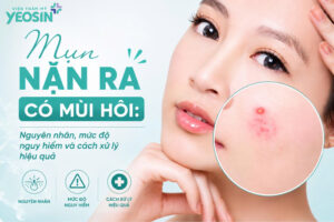 Mụn nặn ra có mùi hôi: Nguyên nhân, mức độ nguy hiểm và cách xử lý hiệu quả