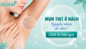 Mụn thịt ở nách: Nguyên nhân, cách xử lý hiệu quả