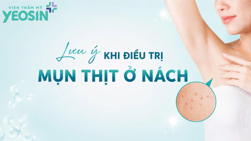 Mụn thịt ở nách: Nguyên nhân, cách xử lý hiệu quả 7 Lưu ý khi điều trị mụn thịt ở nách