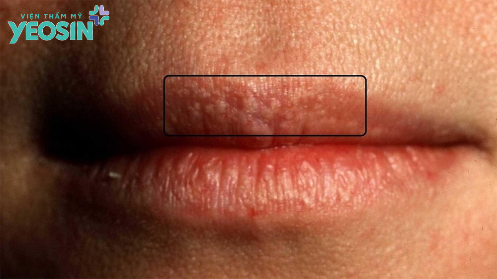 Chi phí điều trị hạt fordyce ở môi giá bao nhiêu tiền là hợp lý?